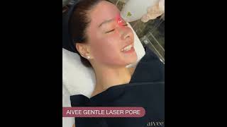 Erich Gonzales l AIVEE GENTLE LASER PORE [upl. by Ibbison]