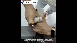 The convolution bandaging method advanced bandaging can better handle the largescale bandaging [upl. by Viccora]