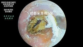 【耳そうじ】Vol24 デイサービス訪問 90代男性Earwax removal professional earcleaningampheadspa salon Kaleidscope TOKYO [upl. by Nosredneh238]