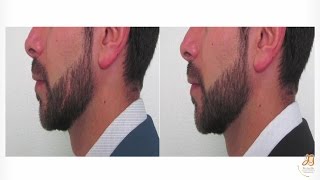 Eliminar Cicatrices en Cejas Cabeza Bigote Y barba con Implantes Capilares  Tratamiento [upl. by Bevon435]