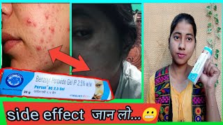 Benzoyl Peroxide Gel 25 Review In Hindi  Uses And Side Effect  miss glossy girl [upl. by Kevin]