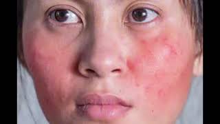 Beauty Tips Series Vol 2 9 Possible side effects of oral Isotretinoin in managing Acne [upl. by Aifas]