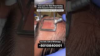 co2 laser treatment for acne scars  DrLalit Kasanas [upl. by Marian828]