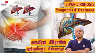 Liver cirrhosis – symptoms and Treatment  கல்லீரல் சிரோசிஸ் – அறிகுறிகள் மற்றும் சிகிச்சைகள் [upl. by Neiv]