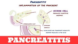 Pancreatitis [upl. by Akkim]