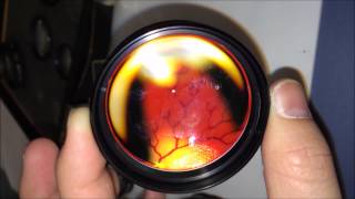 Trying handheld smartphone fundoscopy on practice eyes [upl. by Ragan]