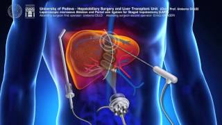 Modified ALPPS totally laparoscopic LAPS  ALPPS modificata LAPS totalmente laparoscopica [upl. by Trevar]