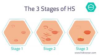 The stages of Hidradenitis Suppurativa [upl. by Eyr179]