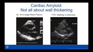 Cardiac Amyloidosis Webinar [upl. by Verney]