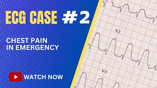 ECG Case 2 Chest Pain in Emergency Department [upl. by Aloke]