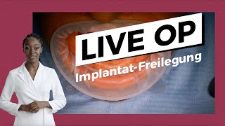 LIVE OP Implantat Freilegung [upl. by Bel59]