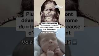 Des bébés ont développé le syndrome du « loupgarou » à cause d’une lotion contre la calvitie [upl. by Einwat554]