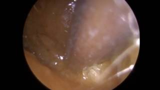 273  Ear Wax Removal Difficult Case with Ear Wax Stuck in Anterior Recess near Eardrum [upl. by Meer]