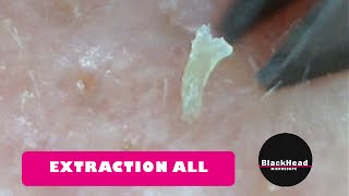 Whitehead and BlackHead RemovalExtraction All [upl. by Ahsatal724]