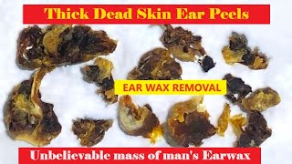 TOTAL OBSTRUCTION  EAR WAX REMOVAL  FULLHD  202312 relaxing satisfying asmr [upl. by Jarv76]