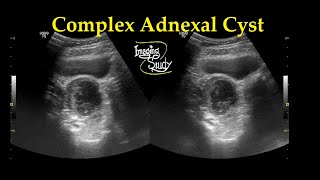 Complex Adnexal Cyst  Ultrasound  Case 27 [upl. by Ammadis141]