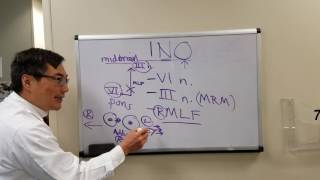 Internuclear Ophthalmoplegia INO [upl. by Rebba]