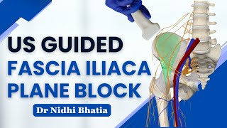 Ultrasound Guided Fascia Iliaca Plane Block I Dr Nidhi Bhatia [upl. by Cornelius]