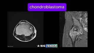 Chondroblastoma [upl. by Urion949]