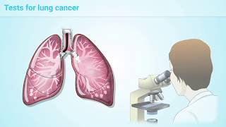 What is Lung Cancer [upl. by Scopp]