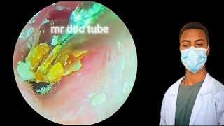 🔴Incredible Ear Wax Removal Watch the Transformationearearwaxearwaxremovalearwaxcleaningrelax [upl. by Bricker]