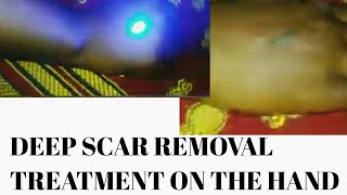 Deep SCAR REMOVAL TREATMENT ON THE HAND UP CLOSE VEIW [upl. by Juni]