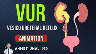 🎬 VUR Vesico Ureteral Reflux CLASSIFICATION amp ANIMATION [upl. by Gerty]