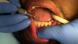 HEAVY TARTAR REMOVAL HIGHLY SATISFYING dental satisfying dentist [upl. by Eelram]