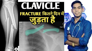 कंप्लीट clavicle Fracture info bone fracture kitne din me thik hota hai haddi kitne din me judti h [upl. by Enelec]