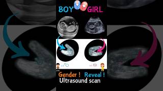 Baby boy baby girl on ultrasound baby shorts ultrasound [upl. by Dix]