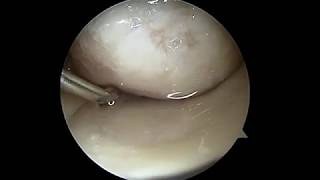 Knee arthroscopy stem cell therapy [upl. by Melva441]