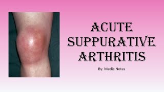 Ortho Acute suppurative arthritisseptic arthritis  clinical feature investigation treatment [upl. by Darcia]