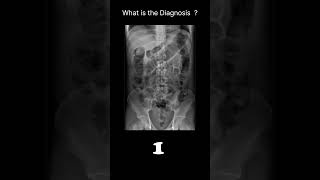 Posttraumatic ileus Abdominal Xray Abnormalities Postoperative ileus 67 radiologychannel007 [upl. by Greenstein790]