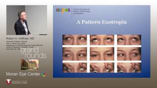 Pattern Strabismus [upl. by Packston]