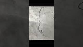 Angioplasty of SVG to PDA Graft with Embolic protection device in post CABG patient after 5 year [upl. by Ultima687]