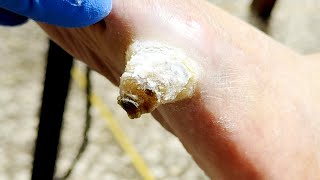 😮How To Put On Shoes Amazing Pedicure Results【Xue Yidao】 [upl. by Lamberto]