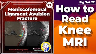 Fig 3A22 Meniscofemoral Ligament Avulsion Fracture [upl. by Eislel951]