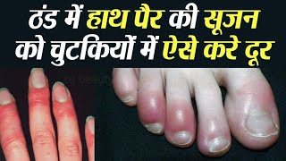 ठंड से हाथ पैरों की उंगलियों मे सूजन व खुजली के घरेलू इलाज़ Home Remedies for Chilblains Perniosis [upl. by Phaidra530]