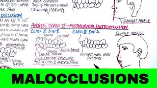 Angles Classification of Malocclusion  Orthodontics [upl. by Hgielyak]