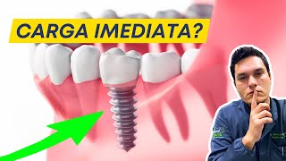 IMPLANTE DENTÁRIO DE CARGA IMEDIATA FUNCIONA MESMO A VERDADE [upl. by Cleland]