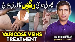 Best Ways to Get Rid of Varicose Veins TESTED│Dr Umair [upl. by Baudin]