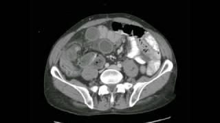 Radiology Rounds  radRoundscom Closed Loop Small Bowel Obstruction [upl. by Dnalyr868]