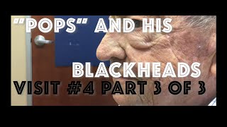 quotPopsquot and his blackhead extractions Visit 5 including skin biopsy [upl. by Anelac]