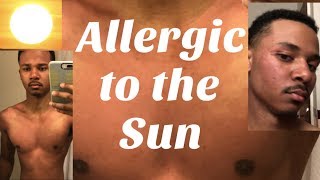 I Am Allergic to Sunlight [upl. by Rici]