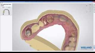 designing a dental model from a Trios Scan 3shape [upl. by Aihselat654]