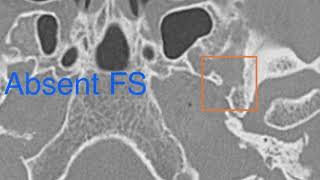 PERSISTENT STAPEDIAL ARTERY [upl. by Epilef]