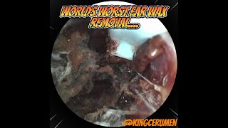 Most Disgusting Ear Wax Removal [upl. by Friedman]