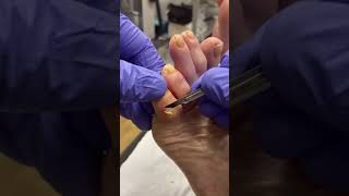 Corn Removal by Podiatrist Expert Solutions for Little Toe Corns [upl. by Ardnikal]