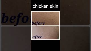 Chicken skin before after skincare beauty [upl. by Klos]