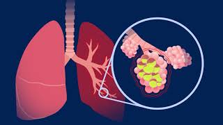 Understanding Pneumococcal Pneumonia [upl. by Latini]